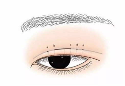 3点式双眼皮整形术效果到底好不好呢