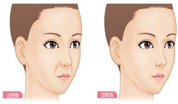 彩光去除黄褐斑能维持几年效果