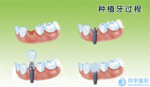 六盘水市自体脂肪注射移植治疗痤疮瘢痕价格表全新一期-均价自体脂肪注射移植治疗痤疮瘢痕12661元