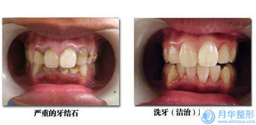 水动力吸脂瘦大腿手术的效果怎么样手术适合哪些人