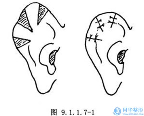 贵阳市曼托妙桃丰胸医生口碑获赞（刘堂浩医生比较强）