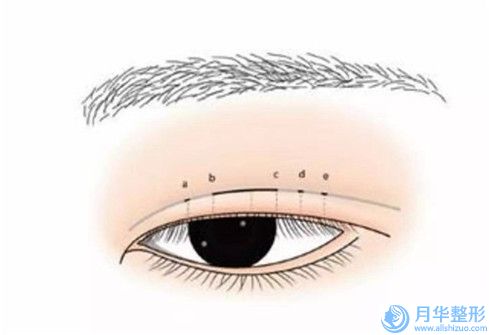 杭州市双眼皮睁眼运动医生排行榜前十强实力实测-徐占锋医生实力赞