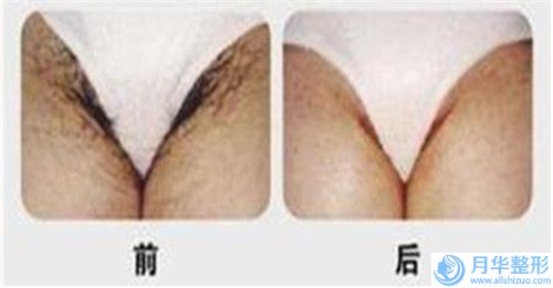 乳房下垂矫正手术对面部表情有什么影响吗