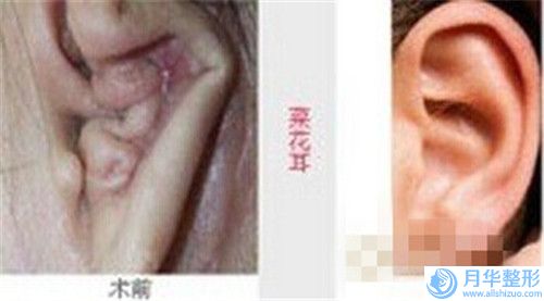 做乳房再造手术术前注意及术后护理_做乳房再造手术术后护理需要注意什么事项