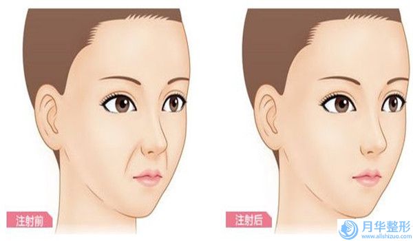 武汉富康整形胶原蛋白填充痘疤价格收费表新版本