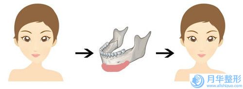 郑州双下巴手术要多少钱，效果如何