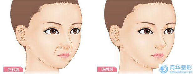 淄博去除痘印报价和费用_淄博去除痘印术多少钱比较合理