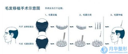 上海颊脂垫切除术瘦脸均价是多少