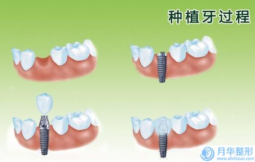 做吸脂提臀的作用及效果介绍,做吸脂提臀效果真的那么好吗