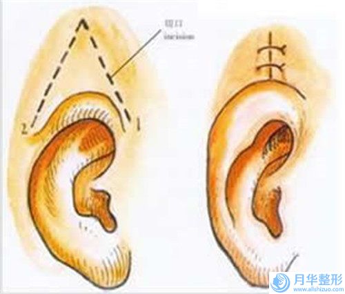 做胸口手术疤痕修复医院推荐：胸口手术疤痕修复医院前20名强强比拼