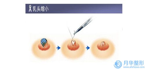 乐山额头脱发整形要多少费用