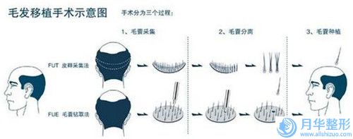 邵阳市贴面耳矫正术收费标准正规2024曝光-邵阳市贴面耳矫正术报价和费用