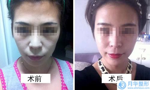 林芝瞳颜医疗美容门诊部收费明细出炉-定妆眉案例