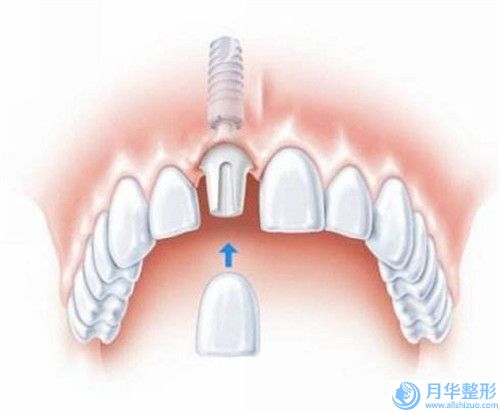 巴音郭楞溶脂术费用大概多少