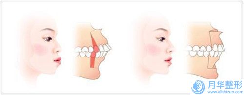 六盘水腰腹抽脂手术的价格都与哪些因素有关